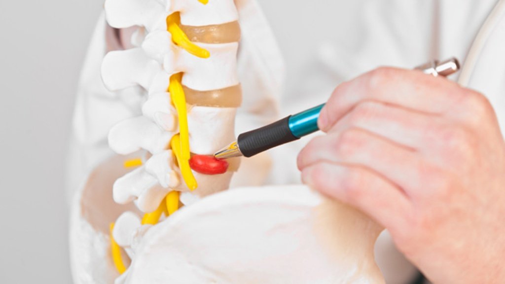 surgery-for-a-herniated-disc-weill-cornell-brain-and-spine-center