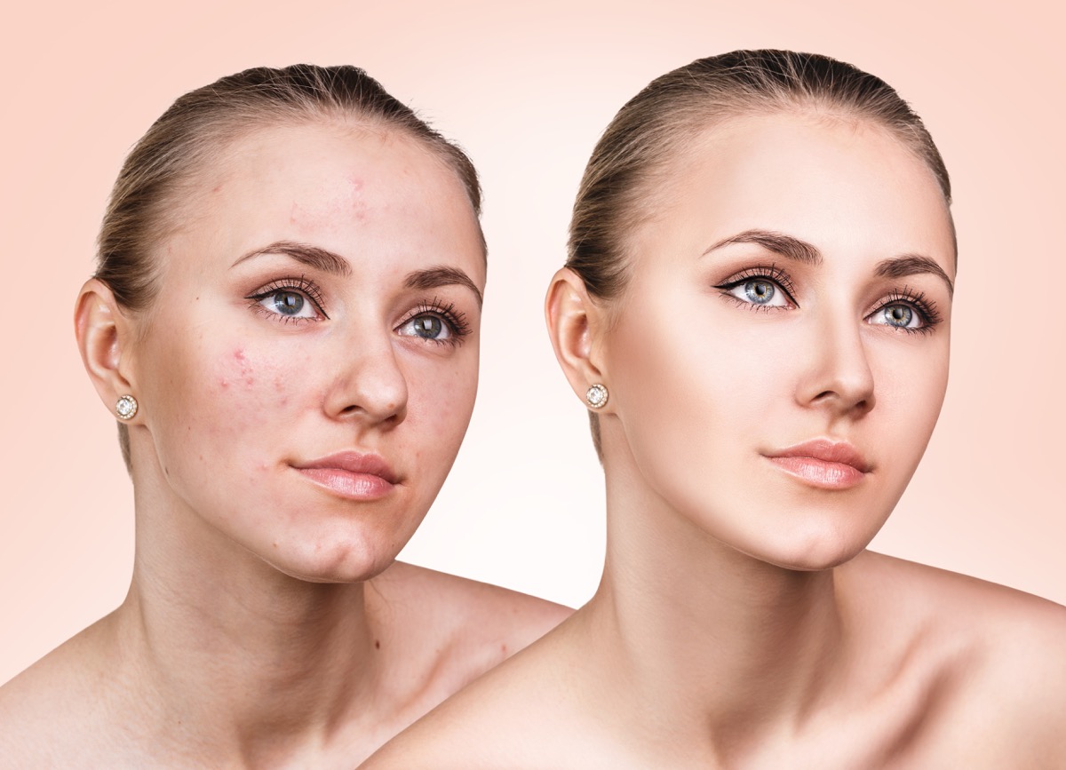 The Skin Before And After Acne Removal By The Experts The Wow Style