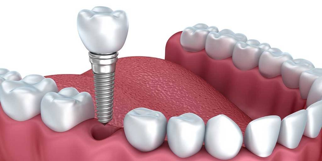 Dental Implants Types Benefits And Complications The WoW Style