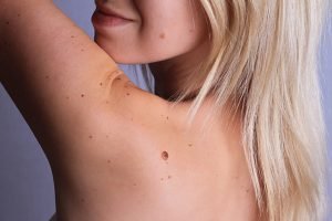 The Top 5 Mole Removal Methods to Consider