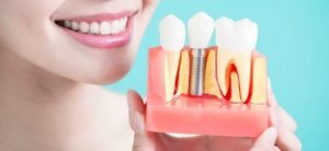 Dental Implants – Types, Benefits, and Complications