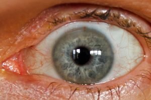 Everything You Need to Know About Cataract Eye Surgery