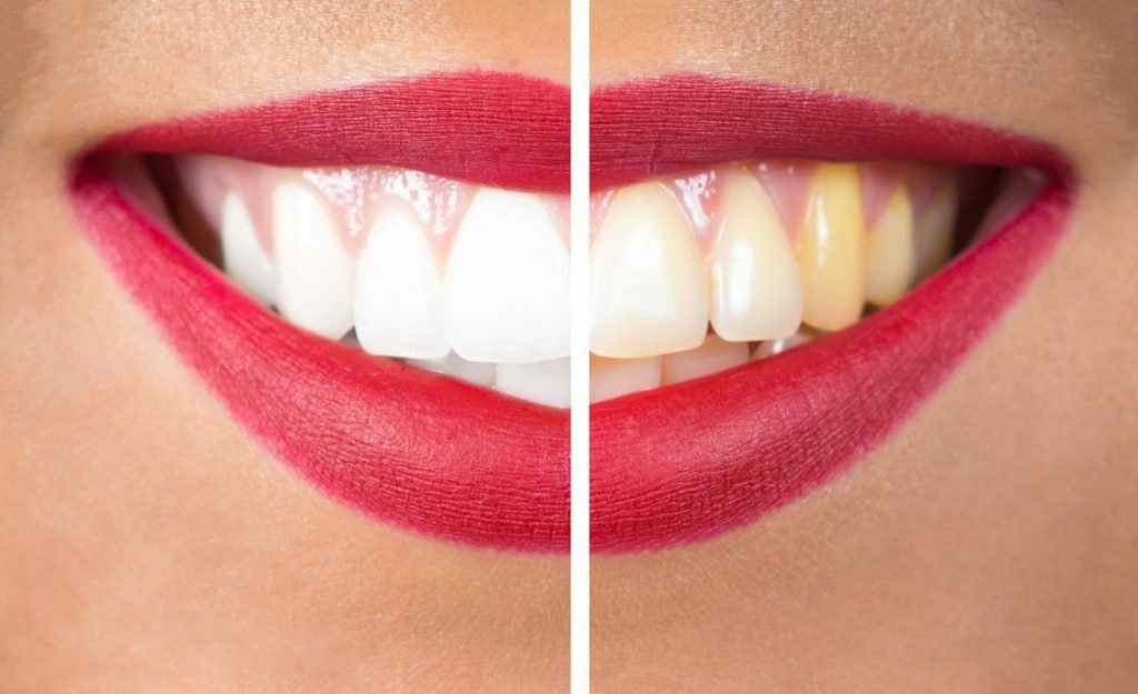 Teeth-whitening-1024x625.jpg