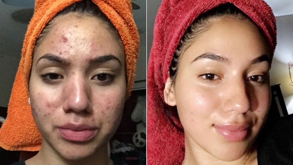 Planning to Go for an Acne Treatment