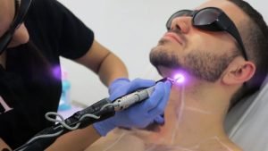 Why Men Need Laser Hair Removal