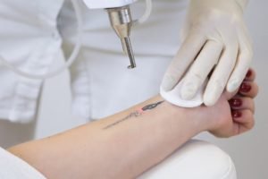 Why Sunshine & Laser Tattoo Removal Don’t Mix