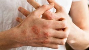 Top Home Remedies for Eczema