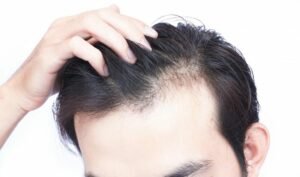 Hair Loss: How Hair Transplant Can Help?
