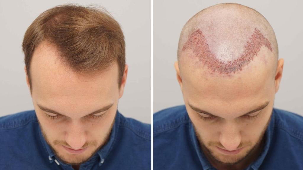 What You Need To Know About Hair Transplant In Dublin