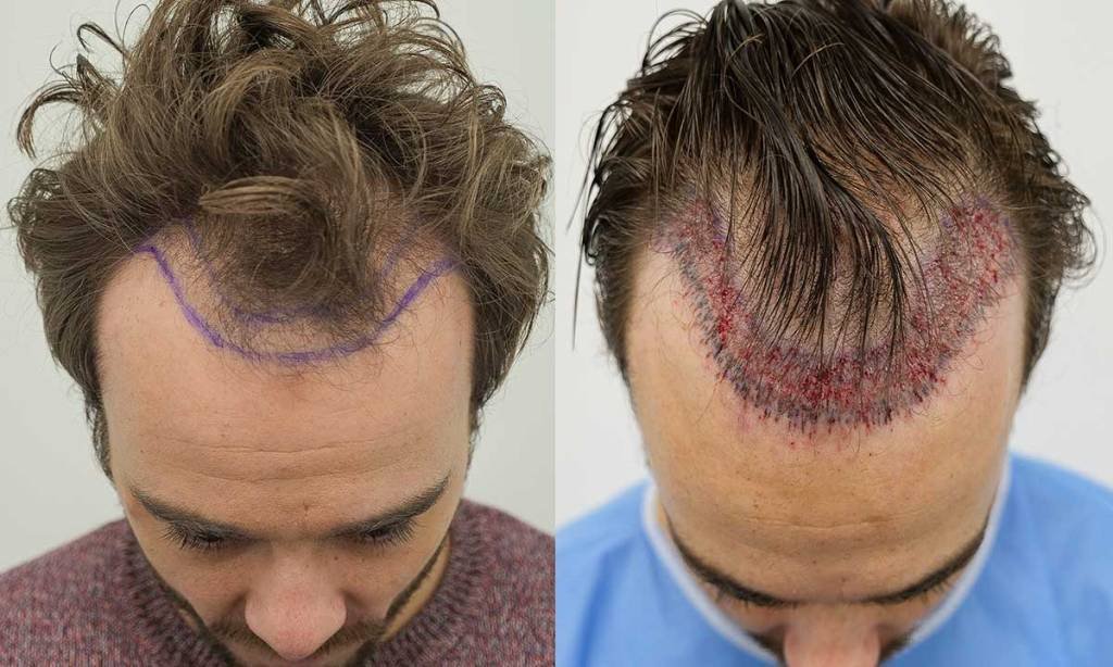 Should You Get A Hair Transplant 