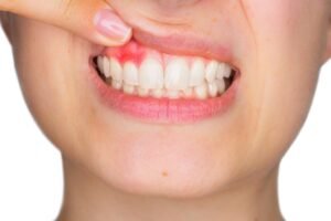 7 Common Causes of Bleeding Gums You Should be Aware of