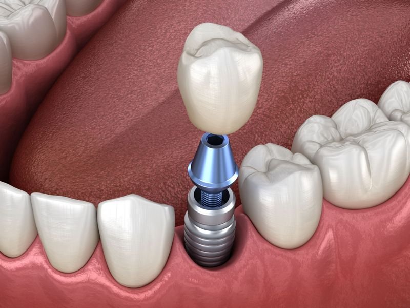 Contribution of Dental Implants to Oral Health