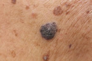 Types of Moles that Increase Risk of Melanoma