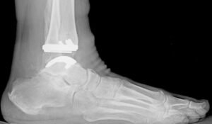 Reasons to Get Total Ankle Replacement