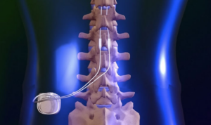 Important Facts About Spinal Cord Stimulation