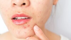 Signs of Hormonal Acne and Hormonal Acne Treatment