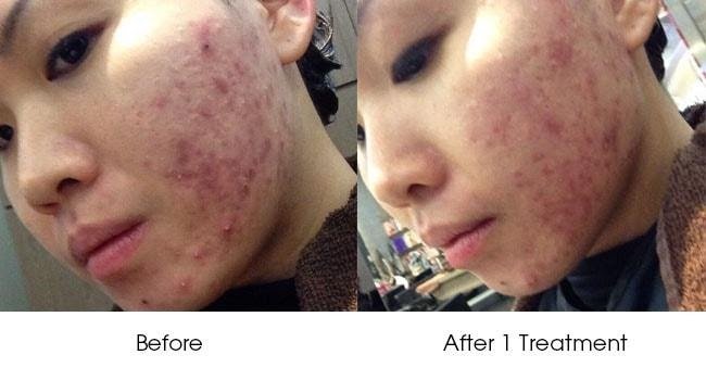 Options for Effective Acne Treatment in Singapore