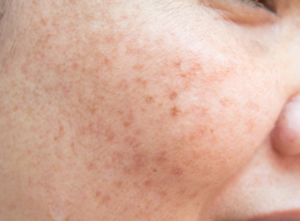 Important Questions That You Need To Answer Before Getting Acne Scar Removal