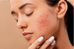 Understanding The Different Levels Of Skin Burns