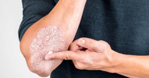 What are the Symptoms of Psoriasis?