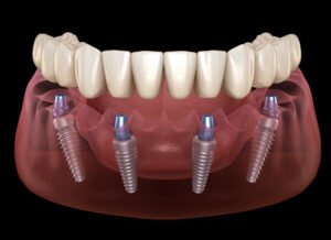 How to Speed Up Recovery After Dental Implant Surgery